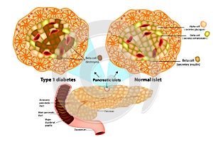 Type 1 diabetes Beta cell destroyed. photo