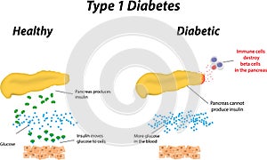 Type 1 Diabetes photo