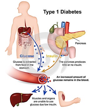 Type 1 diabetes medical  illustration with english description