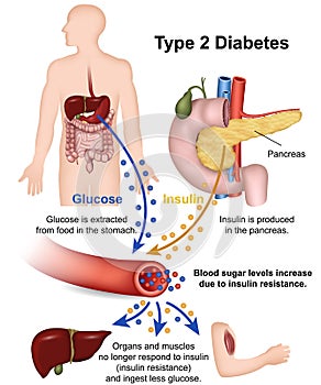 Type 2 diabetes medical  illustration with english description photo