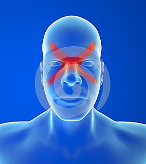 Type headache: Sinus