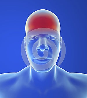 Type headache: Tension