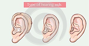 Type of hearing aids