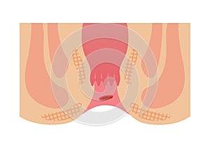 Type of Hemorrhoid flat vector illustration / bleeding hemorrhoids