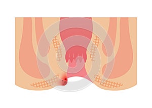 Type of Hemorrhoid flat vector illustration / External hemorrhoid photo