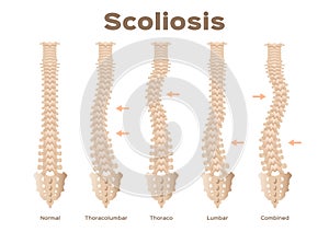 Type, scoliosis medical anatomical / backbone / organ