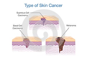 Type of Skin Cancer in 3D vector style.