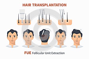 Stages of hair transplantation FUE Unit Extraction photo