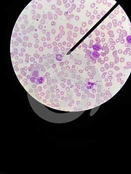 Type of white blood cell (Leukocytes) : Neutrophils