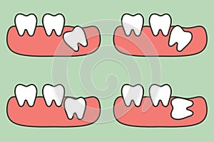 Type of wisdom tooth affect to other teeth