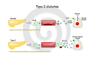 Types 2 of Diabetes Mellitus. Comparison of cell work in diabetes and in a healthy body