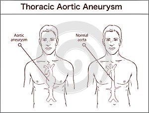 Types of abdominal aortic aneurysm. normal aorta and enlarged vessels. Vector diagram photo