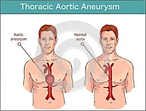 Types of abdominal aortic aneurysm. normal aorta and enlarged vessels. Vector diagram photo