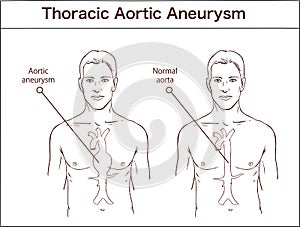 Types of abdominal aortic aneurysm. normal aorta and enlarged vessels. Vector diagram