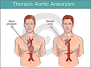 Types of abdominal aortic aneurysm. normal aorta and enlarged vessels. Vector diagram