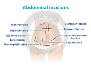 Types of abdominal incision for surgery vector illustration isolated on white background.