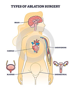 Types of ablation surgery with brain and cardiac example outline diagram