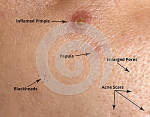 Types of acne and acne on the skin. Enlarged pores, Inflamed pimple, Blackheads, Acne scars, Papule