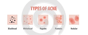 Types of acne diagram illustration vector on white background, B
