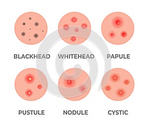 Types of acne illustration. Pimples, skin pores, blackhead, whitehead, scar, comedone. Skincare problems and