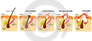 Tipos de acné. abrir cerrado acné acné. estructura de piel. infografias. 