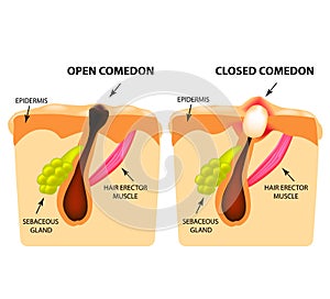 Types of acne. Open comedones, closed comedones, Skin structure. Infographics. Vector illustration on isolated background