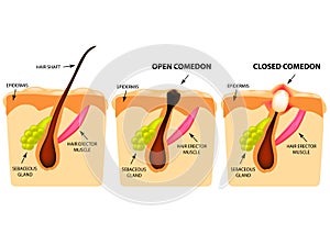 Types of acne. Open comedones, closed comedones, Skin structure. Infographics. Vector illustration on isolated background photo