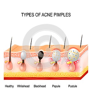 Types of acne pimples