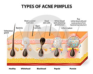 Types of acne pimples