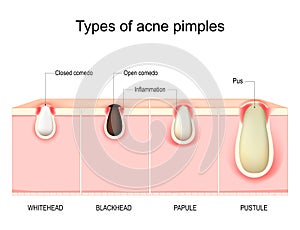 Types of acne pimples. Cross section of human Skin