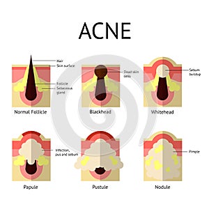 Types of acne pimples. Healthy skin, Whiteheads and Blackheads, Papules and Pustules in flat style.
