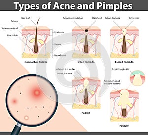 Types of Acne and Pimples, vector illustration