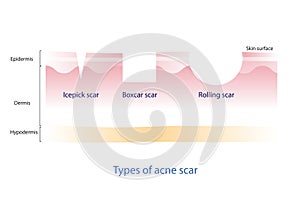 Types of acne scar vector.