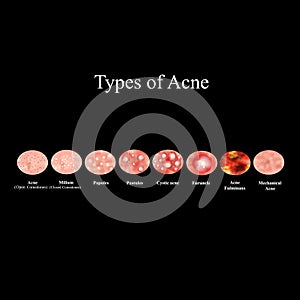 Types of Acne Skin inflammation. Pimples, boils, whitehead, closed comedones, papules, pustules, cystic acne