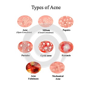 Types of Acne Skin inflammation. Pimples, boils, whitehead, closed comedones, papules, pustules, cystic acne