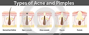 Types of acne, structure of pimple, vector illustration