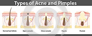 Types of acne, structure of pimple, vector illustration photo
