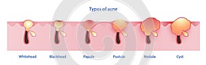Types of acne vector on white background. Formation of noninflammatory and inflammatory acne.