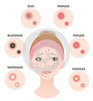 Types of acne and woman face illustration. whitehead,black head, papules, and pustules. Beauty skin care concept