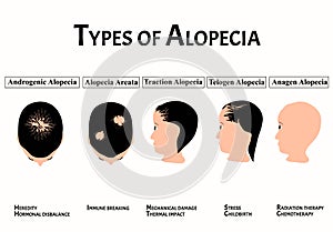 Types of alopecia. Bald spot, baldness, Alopecia mesotherapy. Causes of baldness. Infographics. Vector illustration on