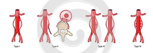 Types of aneurysm