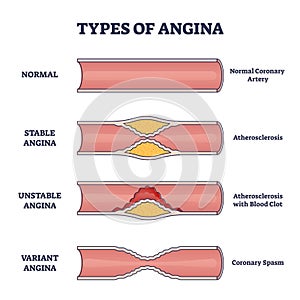 Types of angina as chest pain and heart problem explanation outline diagram