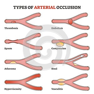 Types of arterial occlusion and circulatory flow disorders outline diagram