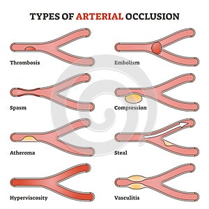 Types of arterial occlusion and circulatory flow disorders outline diagram photo