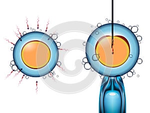 Types of artificial fertilization of the egg by sperm