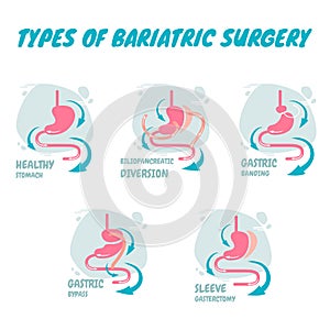 Types of bariatric surgery, it is process for the digestive system in stomach, A new types of bariatric surgery
