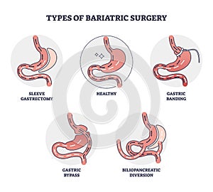 Types of bariatric surgery and stomach reduction control outline diagram