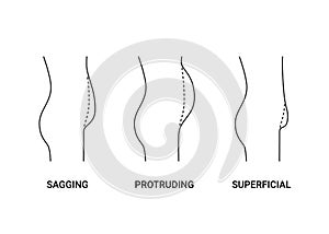 Types bellies of human body, big belly with overweight, line side view. Sagging, protruding and superficial tummy. Loss