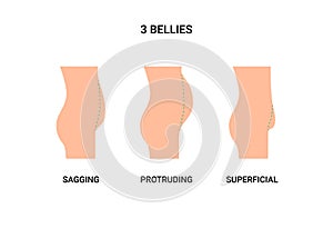 Types bellies of human body, big belly with overweight. Sagging, protruding and superficial tummy. Loss weight, reduce photo