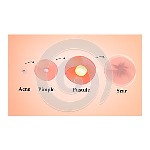 Types of blackheads, pustule, acne. Scarred skin after acne and acne. Infographics. Vector illustration on isolated